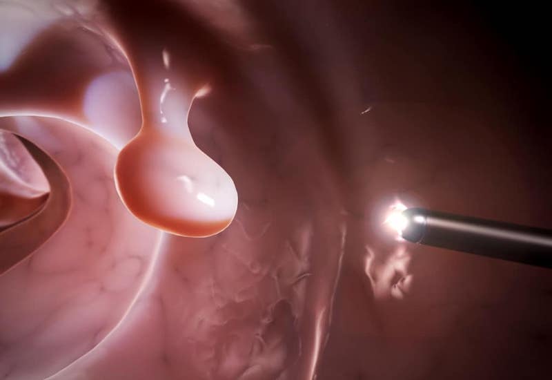 Tính toán khối u có thể bắt nguồn từ polyp lành tính ở đại tràng